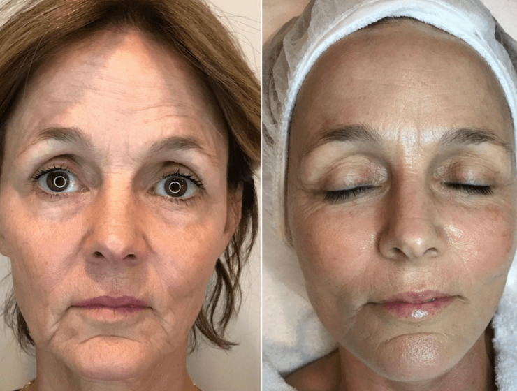 Before and after Cryo Facial (5 sessions)