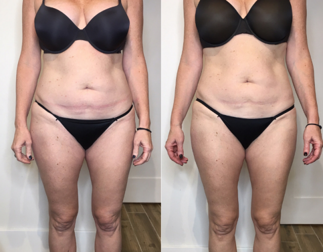 Before and after Cryo Slimming for the abdomen (3 sessions)