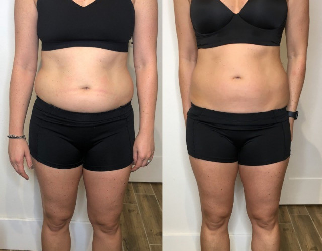 Before and after Cryo Slimming for the belly (5 sessions)